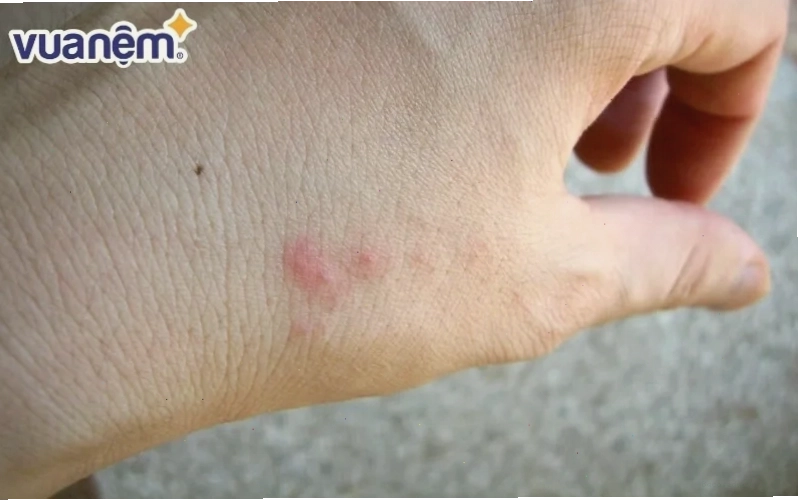 Nhận diện rệp giường qua các vết cắn trên da